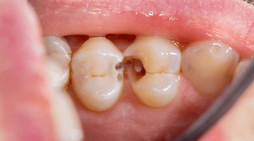 Caries: ¿cómo las tratamos?